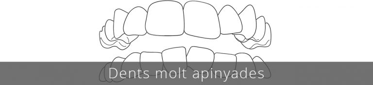 L'apinyament dental pot fer que les dents estiguin molt torts i acumulin placa i desenvolupin càries i malaltia periodontal amb més facilitat.