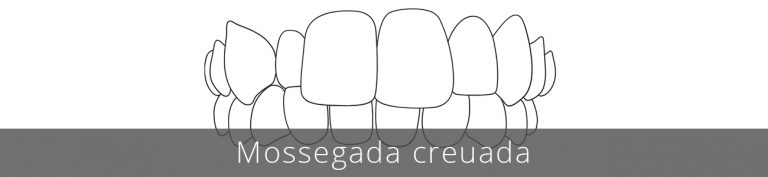 La mossegada creuada pot provocar desgast dental, malaltia periodontal i pèrdua òssia.