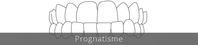 El prognatisme pot provocar problemes de masticació, deteriorament important de les dents i les genives, dolor a la mandíbula i problemes en l'articulació.